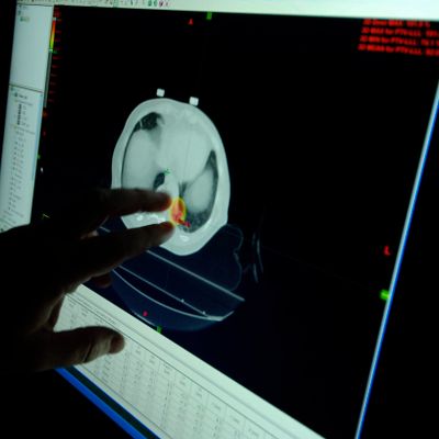 The unique needs of young cancer survivors are often overlooked