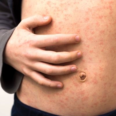 Measles is spreading. Are you safe?